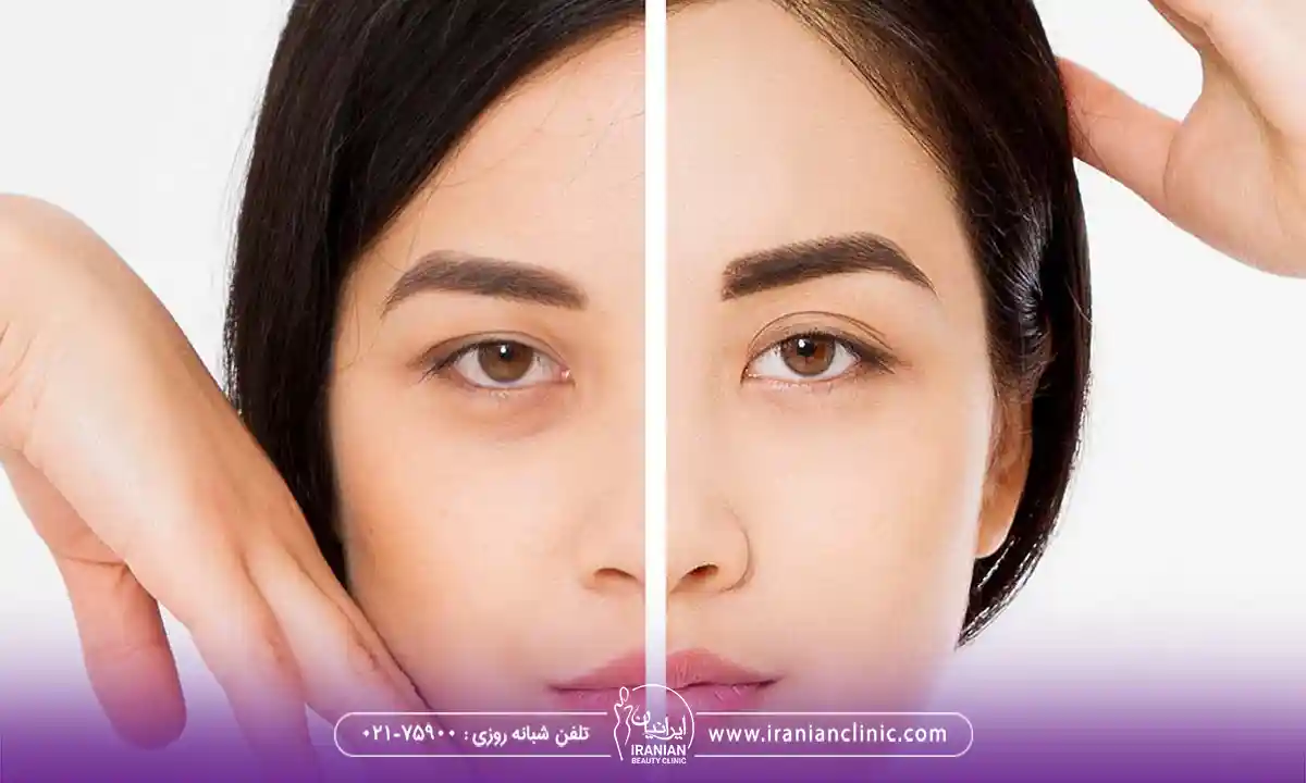 نقاط تزریق بوتاکس برای لیفت ابرو