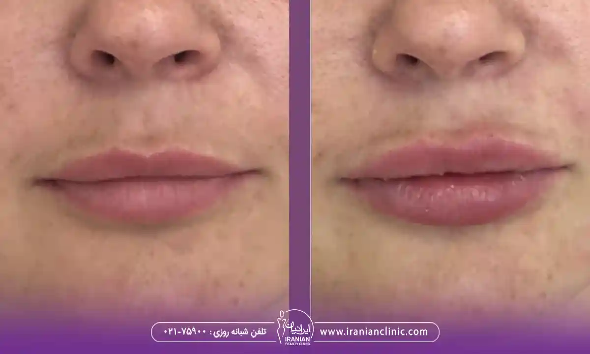 راهکارهای کاهش عوارض جانبی فیلر استایلج