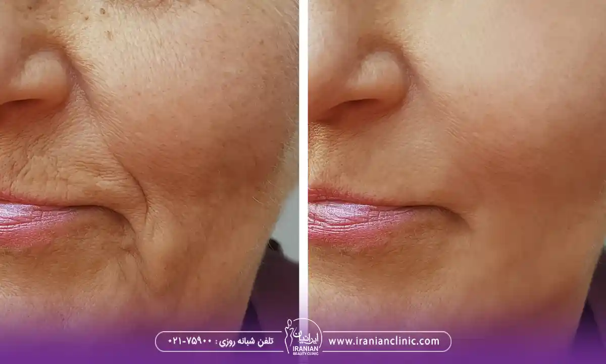 کاندیدای مناسب برای کانتورینگ صورت با فیلر چه کسی است؟