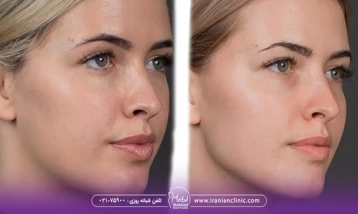 هزینه کانتورینگ صورت با فیلر در کلینیک زیبایی ایرانیان