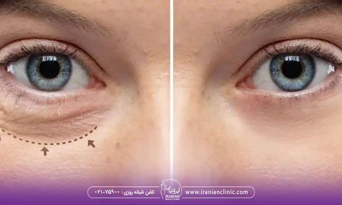 عوامل موثر بر بهترین سن برای عمل بلفاروپلاستی