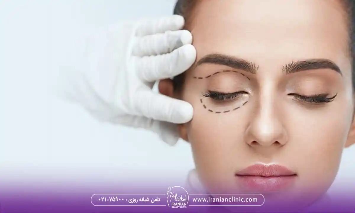 بهترین سن عمل بلفاروپلاستی در زنان