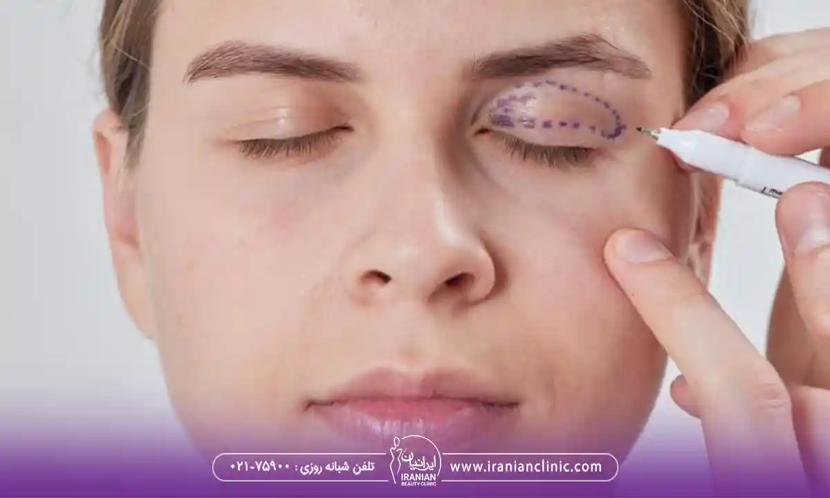 کاندیدای مناسب برای عمل چشم گربه ای