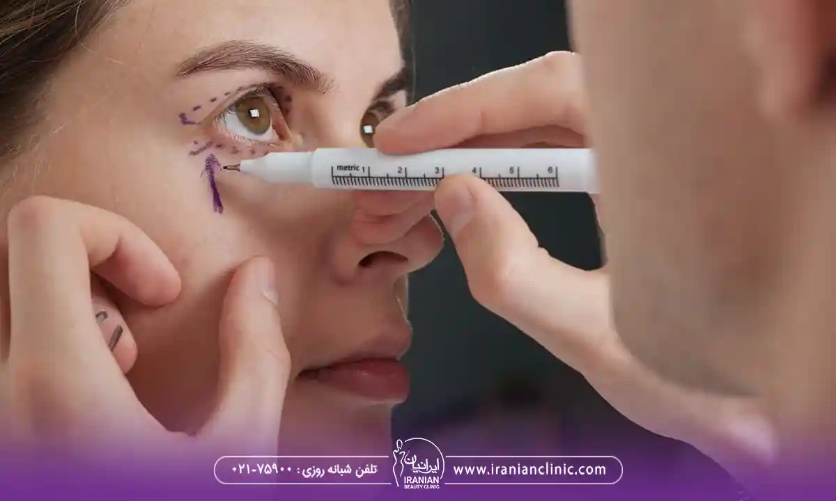انواع بلفاروپلاستی چشم گربه ای