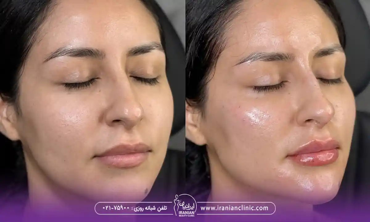 کانتورینگ صورت با فیلر در کلینیک زیبایی ایرانیان