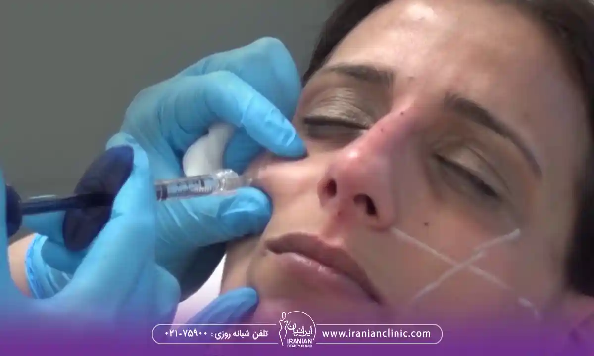 تزریق ژل به سیب گونه چرا انجام می شود؟