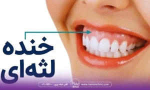 اصلاح لبخند لثه ای با تزریق ژل