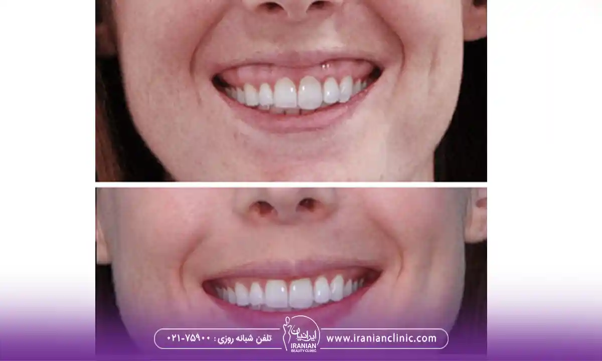 ماندگاری ژل لب بعد از اصلاح لبخند لثه ای