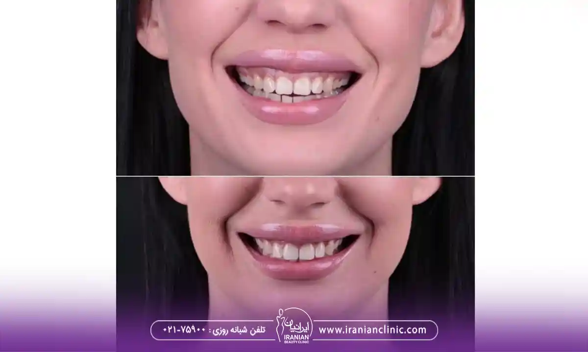 نحوه اصلاح لبخند لثه ای با تزریق ژل، تصویر خانمی که تزریق ژل اصلاح لبخند لثه انجام داده