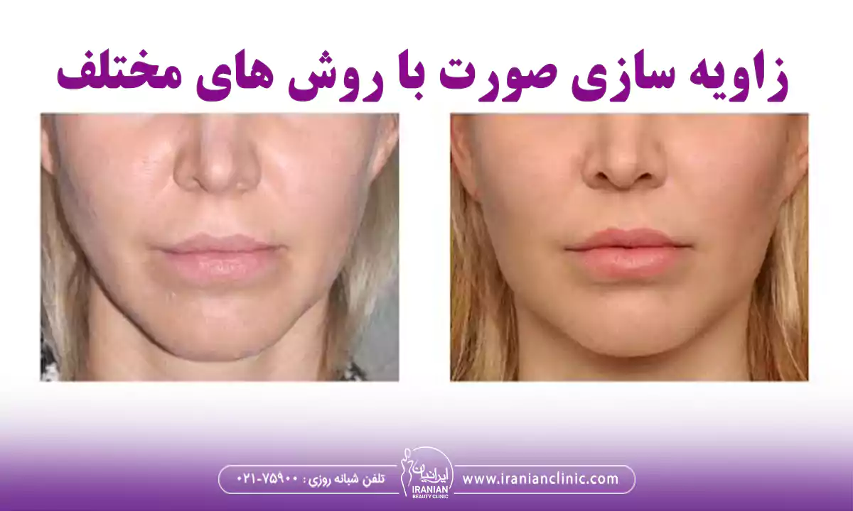 انواع روش های زاویه سازی صورت کدامند؟