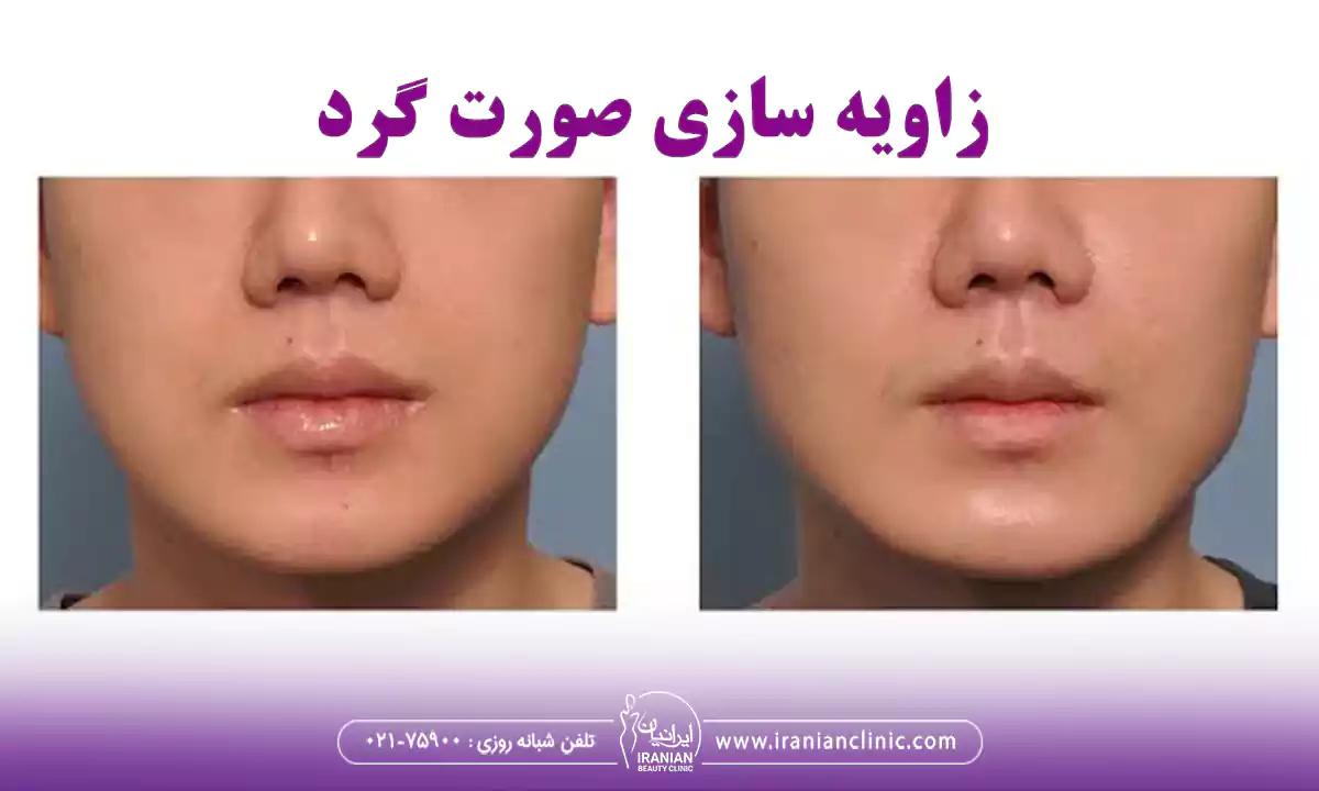 کاندیدای مناسب برای زاویه سازی صورت