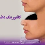 کانتورینگ دائمی صورت چیست؟