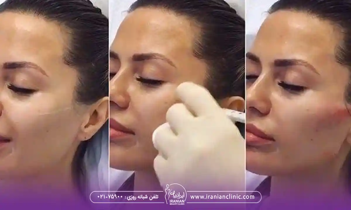 انواع کانتورینگ دائمی صورت کدامند؟