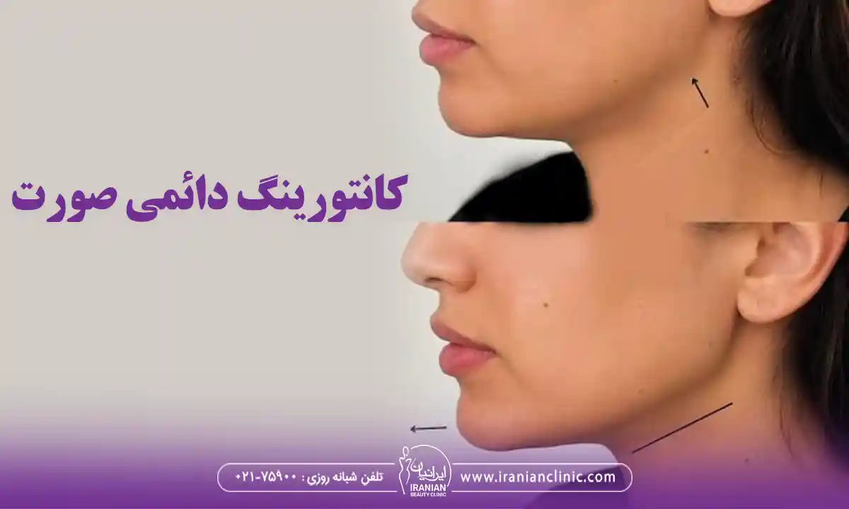 کانتورینگ دائمی صورت چیست؟
