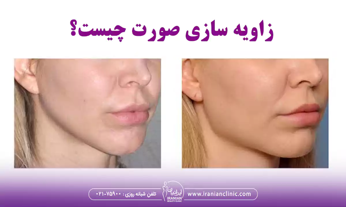 زاویه سازی صورت چیست؟