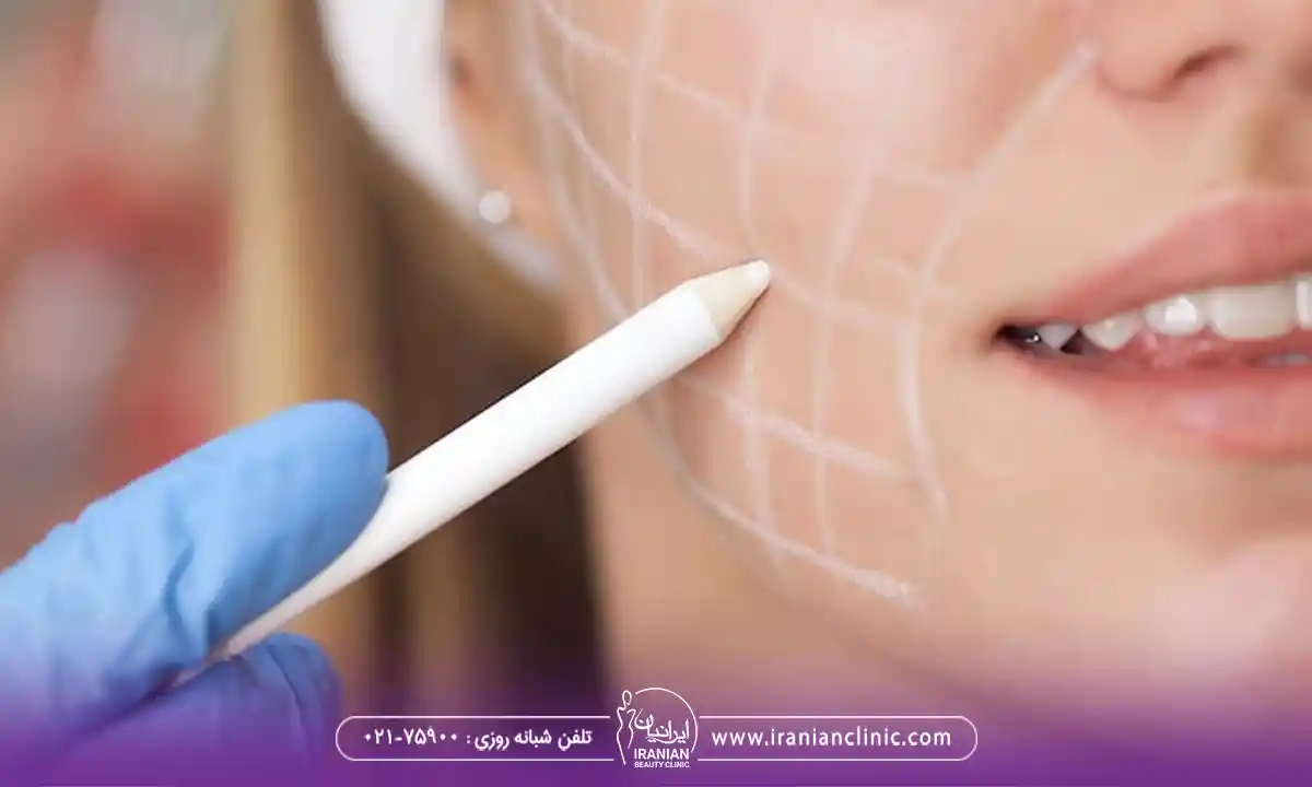 تزریق ژل سیب گونه به چه صورت انجام می شود؟