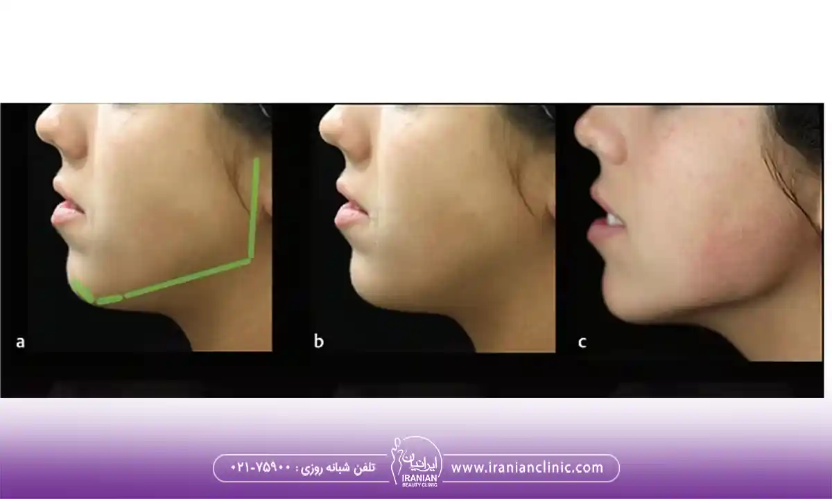 مادلینگ صورت و اصلاح فرورفتگی کنار چانه و زاویه فک