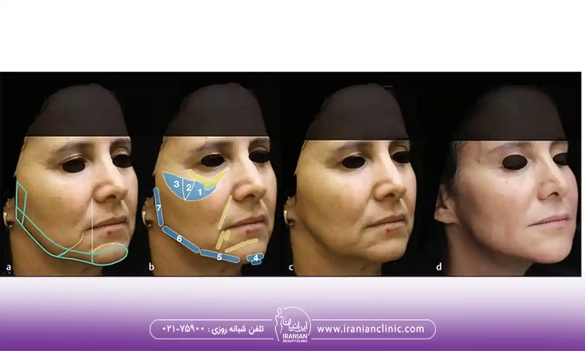 مادلینگ صورت و اصلاح چانه