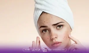 مراحل فیشیال پوست جوش دار