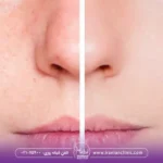 فیشیال برای منافذ باز پوست