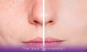 فیشیال برای منافذ باز پوست