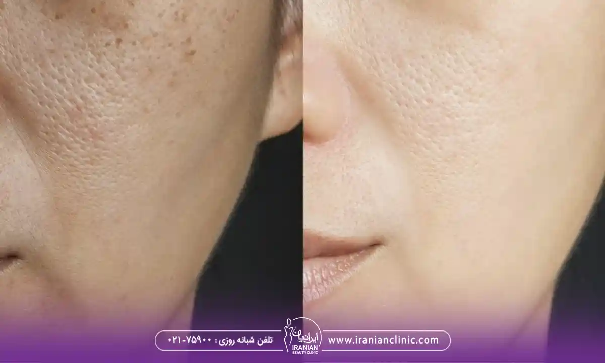 مراحل فیشیال تخصصی برای درمان منافذ باز