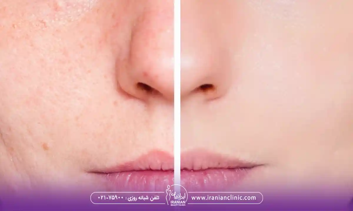 فیشیال برای منافذ باز پوست