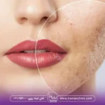 عوارض فیشیال صورت و معایب فیشیال چیست؟