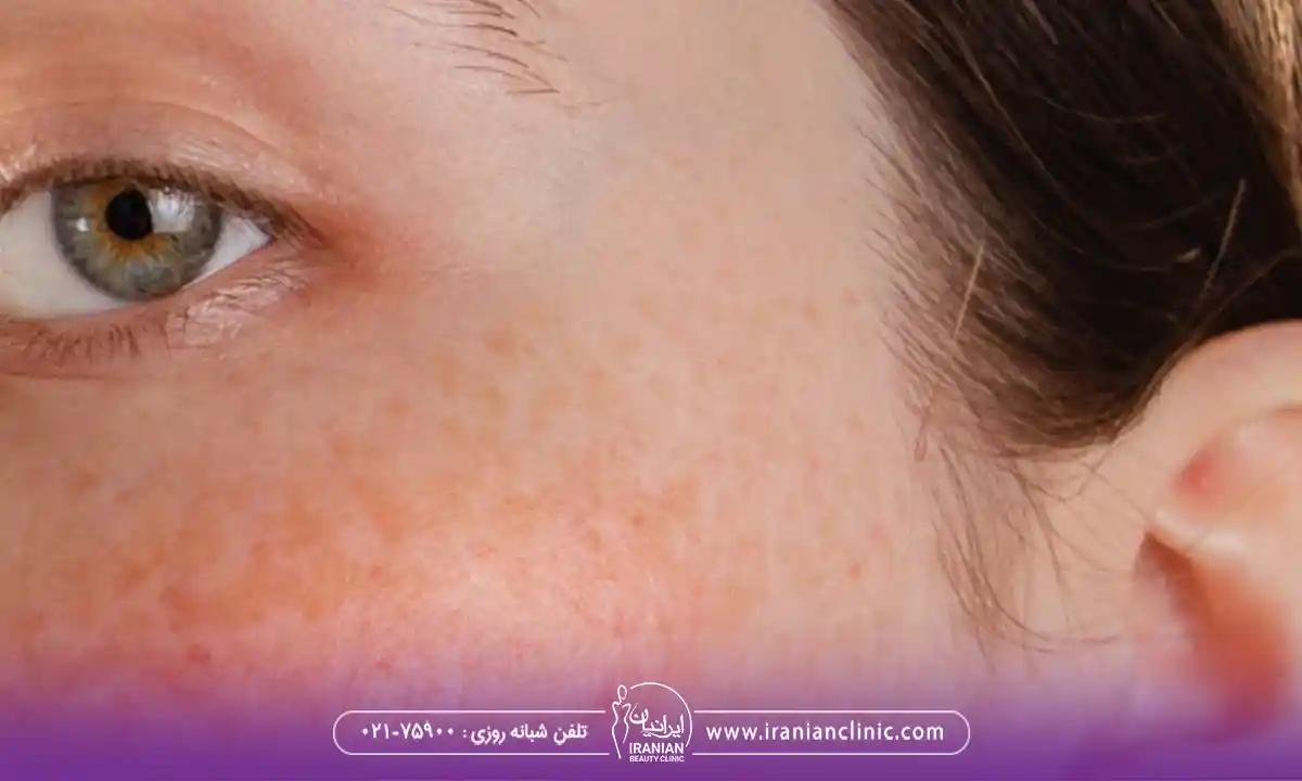 حساسیت به مواد از عوارض فیشیال صورت