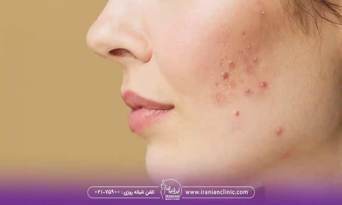جوش و آکنه از عوارض فیشیال صورت