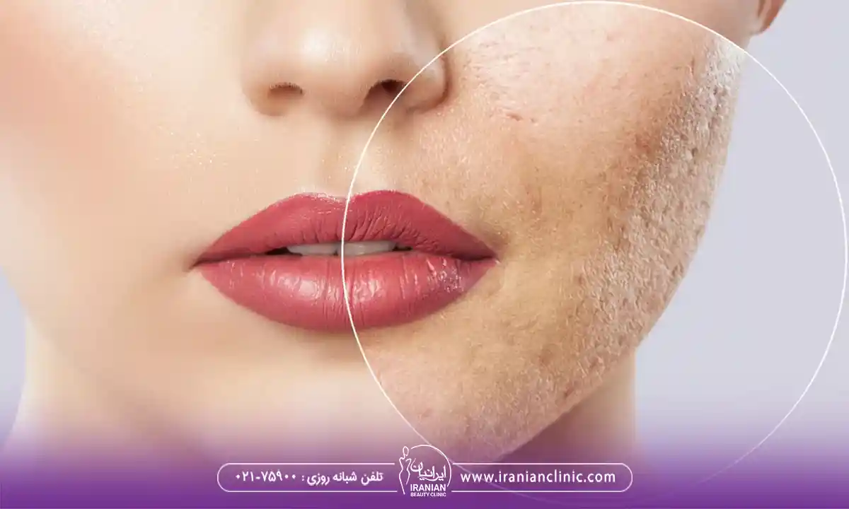 عوارض فیشیال صورت و معایب فیشیال چیست؟