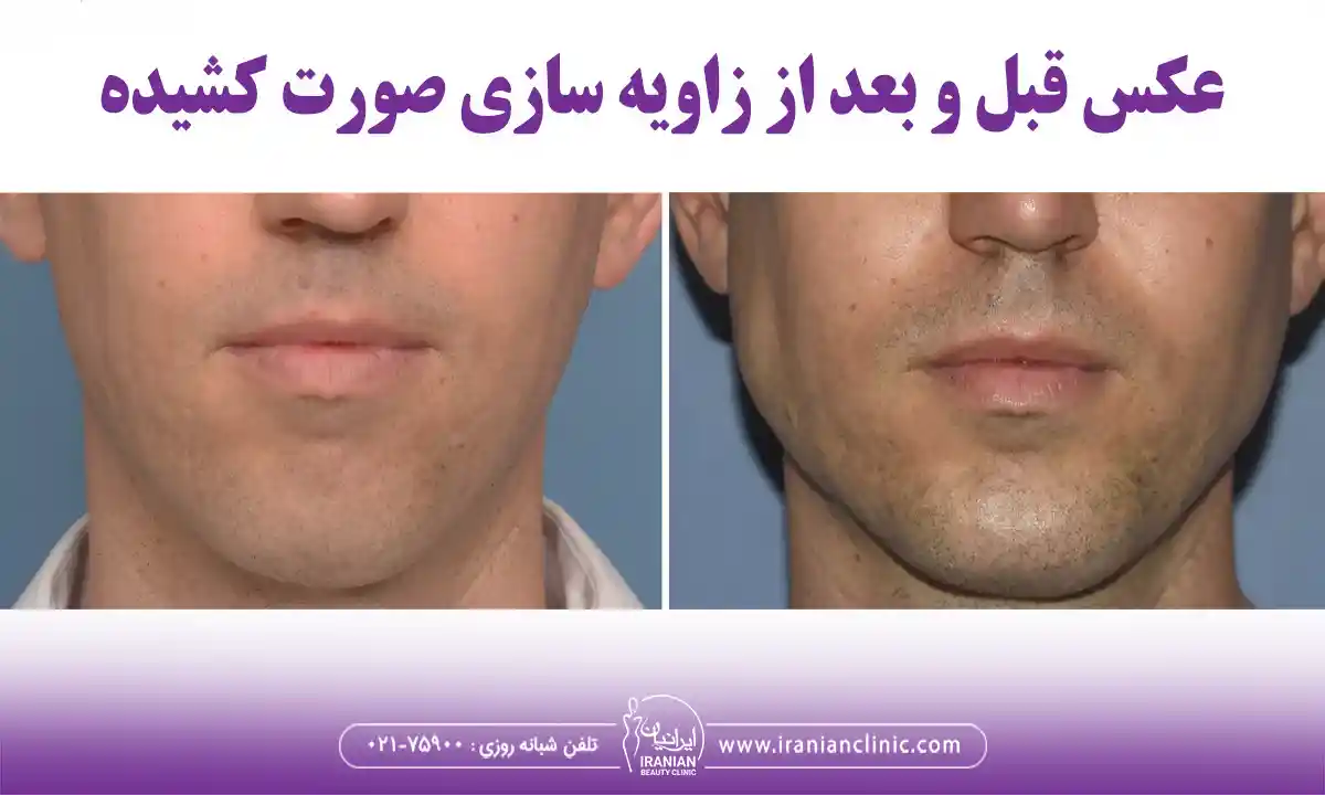 زاویه سازی صورت کشیده آقایی در کلینیک زیبایی ایرانیان