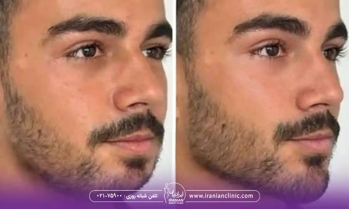 ماندگاری زاویه سازی صورت در مردان