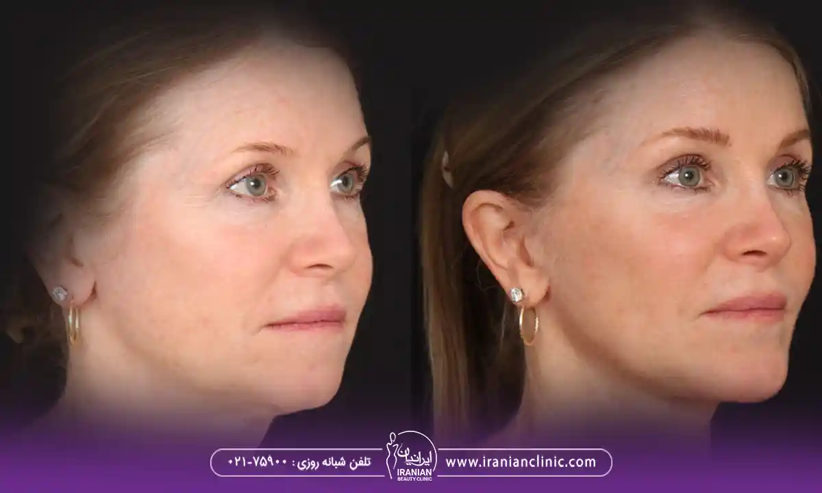 ماندگاری زاویه سازی صورت با تزریق فیلر