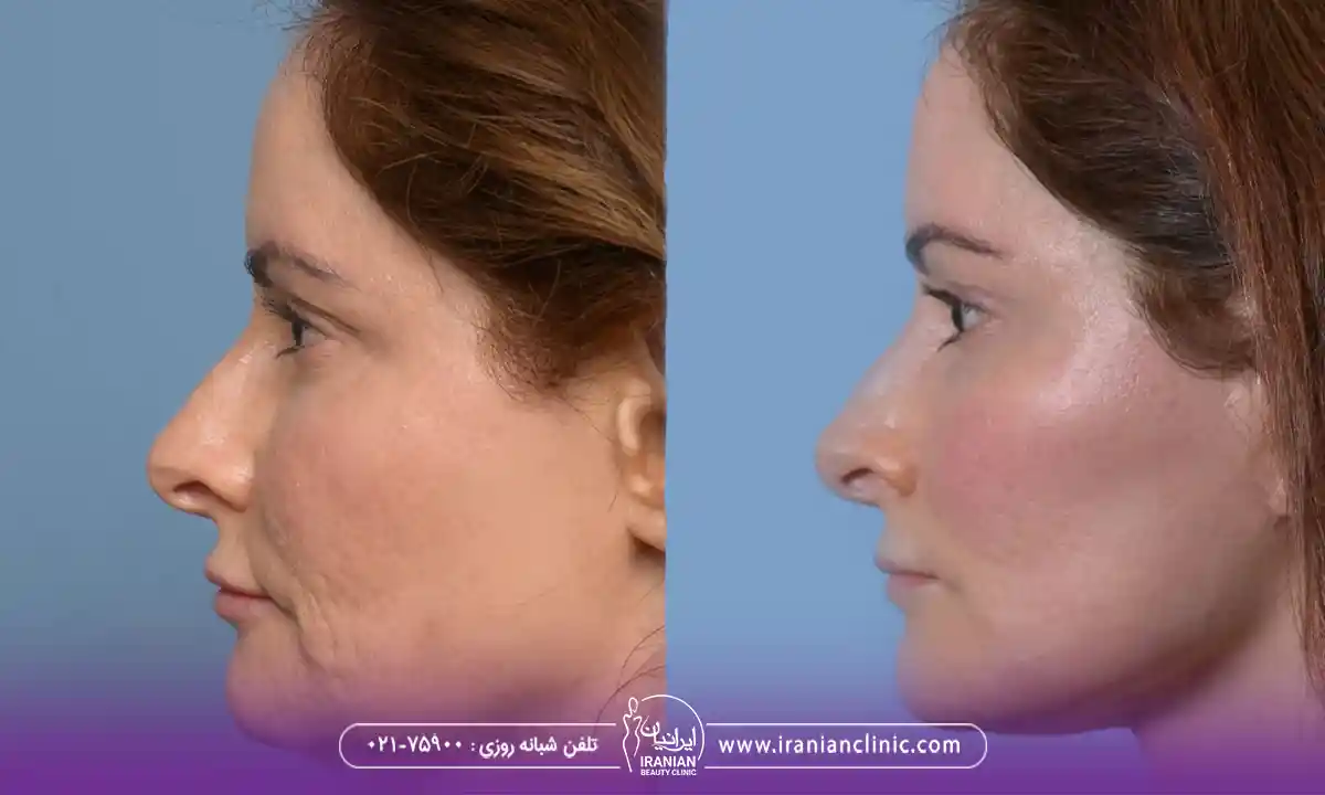 نحوه افزایش ماندگاری زاویه سازی صورت